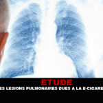 ÉTUDE : Des lésions pulmonaires dues à la e-cigarette ?