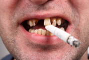 SANTE : Jusqu&rsquo;a quel point le tabagisme affecte votre dentition ?