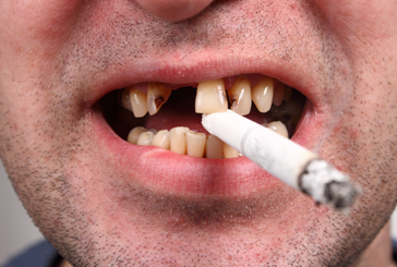 SANTE : Jusqu&rsquo;a quel point le tabagisme affecte votre dentition ?