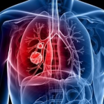 lung