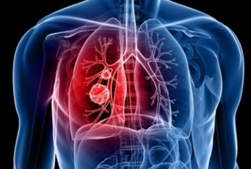 SANTÉ : Un professeur fait un point sur le cancer du poumon.