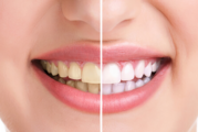 ETUDE : Contrairement au tabagisme, l&rsquo;e-cigarette ne tache pas les dents !