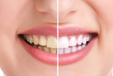 ETUDE : Contrairement au tabagisme, l&rsquo;e-cigarette ne tache pas les dents !